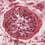 Mecanismos regulatorios y patogénicos en enfermedades inflamatorias del tracto genital masculino