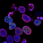 Sistema inmune en procesos inflamatorios y en cáncer